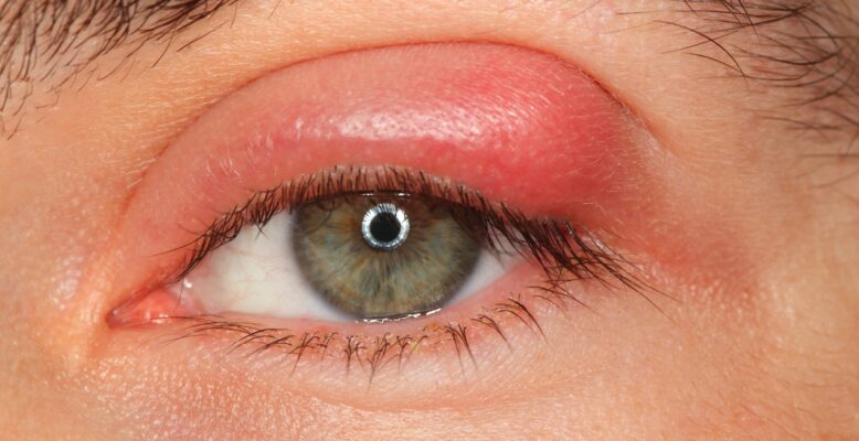 illness person eye with sty and pus be caused by eyelash extension looking into the camera. LavisLash US